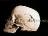 Skull broken by injury